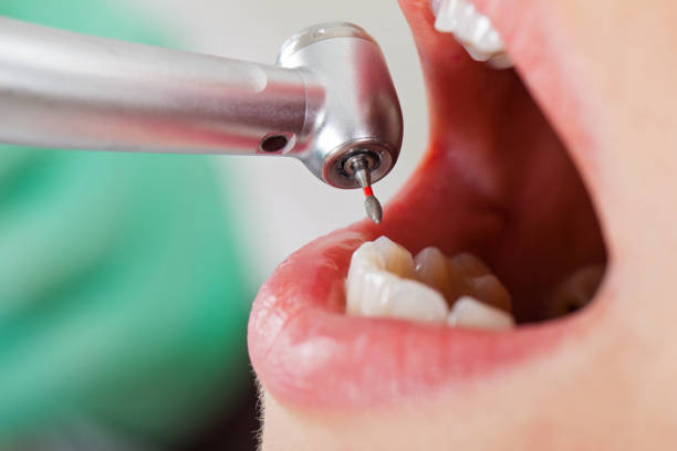 Best Emergency Wisdom Teeth Removal in Livingston, TX
